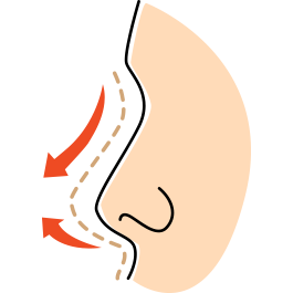 เสริมจมูก