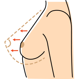 เสริมหน้าอก