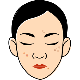 สิว/ฝ้า/กระ