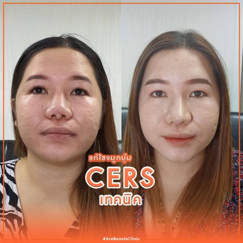 จมูก-ตัด จมูก-ตัด